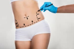 Liposuction and body sculpting